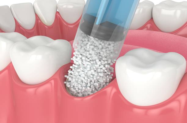 Greffe osseuse dentaire prix : Est-ce un investissement rentable pour votre santé bucco-dentaire ?